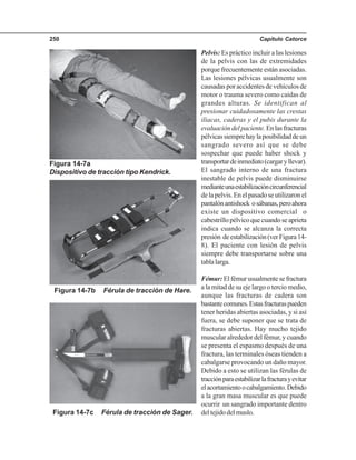 Capítulo Catorce250
Figura 14-7c Férula de tracción de Sager.
Figura 14-7b Férula de tracción de Hare.
Figura 14-7a
Dispositivo de tracción tipo Kendrick.
Pelvis: Es práctico incluir a las lesiones
de la pelvis con las de extremidades
porque frecuentemente están asociadas.
Las lesiones pélvicas usualmente son
causadas por accidentes de vehículos de
motor o trauma severo como caídas de
grandes alturas. Se identifican al
presionar cuidadosamente las crestas
iliacas, caderas y el pubis durante la
evaluacióndelpaciente.Enlasfracturas
pélvicassiemprehaylaposibilidaddeun
sangrado severo así que se debe
sospechar que puede haber shock y
transportardeinmediato(cargaryllevar).
El sangrado interno de una fractura
inestable de pelvis puede disminuirse
medianteunaestabilizacióncircunferencial
de la pelvis. En el pasado se utilizaron el
pantalónantishock osábanas,peroahora
existe un dispositivo comercial o
cabestrillopélvicoquecuandoseaprieta
indica cuando se alcanza la correcta
presión deestabilización(verFigura14-
8). El paciente con lesión de pelvis
siempre debe transportarse sobre una
tablalarga.
Fémur:Elfémurusualmentesefractura
a la mitad de su eje largo o tercio medio,
aunque las fracturas de cadera son
bastantecomunes.Estasfracturaspueden
tener heridas abiertas asociadas, y si así
fuera, se debe suponer que se trata de
fracturas abiertas. Hay mucho tejido
muscular alrededor del fémur, y cuando
se presenta el espasmo después de una
fractura, las terminales óseas tienden a
cabalgarse provocando un daño mayor.
Debido a esto se utilizan las férulas de
tracciónparaestabilizarlafracturayevitar
elacortamientoocabalgamiento.Debido
a la gran masa muscular es que puede
ocurrir un sangrado importante dentro
deltejidodelmuslo.
 