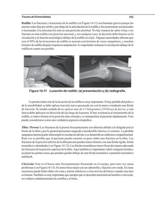 Trauma de Extremidades 253
Rodilla: Las fracturas y luxaciones de la rodilla (ver Figura 14-11) son bastante graves porque las
arteriasestánfijasporarribayporabajodelaarticulacióndelarodillayfrecuentementesonlaceradas
o lesionadas si la articulación está en una posición anormal. No hay manera de saber si hay o no
fractura en una rodilla con posición anormal, y en cualquier caso, la decisión debe basarse en la
circulaciónylafunciónneurológicadebajodelarodillaenelpie.Algunasautoridadesafirmanque
casi el 50% de las luxaciones de rodilla se asocian con lesiones de vasos sanguíneos, y muchas
lesionesderodilladespuésrequierenamputación.Esimportanterestaurarlacirculacióndebajodela
rodilla en cuanto sea posible.
Figura 14-11 Luxación de rodilla: (a) presentación y (b) radiografía.
Laprontareduccióndelaluxacióndelarodillaesmuyimportante.Sihaypérdidadelpulsoo
de la sensibilidad, se debe aplicar tracción suave que puede ser con la mano o mediante una férula
de tracción. Se tendrá cuidado de no aplicar más de 4.5 kilogramos (10 libras) de fuerza, y esta
fuerza debe aplicarse en dirección del eje largo de la pierna. Si hay resistencia al estiramiento de la
rodilla, se inmovilizará en la posición más cómoda y se transportará al paciente rápidamente. Esto
puede considerarse como una verdadera urgencia ortopédica.
Tibia / Peroné: Las fracturas de la pierna frecuentemente son abiertas debido a la delgada piel al
frente de la tibia y por lo general presentan sangrado considerable interno y/o externo. La pérdida
sanguíneainternapuedeinterrumpirlacirculacióndelpiesisedesarrollaunsíndromecompartimental.
Rara vez es posible que el paciente pueda sostener su peso sobre una fractura en la tibia. Las
fracturasdelaporcióninferiordelatibia/peronépuedeninmovilizarseconunaférularígida,férula
neumáticaoalmohadas(verFigura14-12).Lasférulasneumáticasinmovilizandemaneraadecuada
lasfracturasdelaporciónsuperiordelatibia.Aquítambiénesimportantecubrircualquierheriday
acojinar las puntas óseas que puedan quedar debajo de una férula neumática o pantalón neumático
antishock.
Clavícula: Este es el hueso más frecuentemente fracturado en el cuerpo, pero rara vez causa
problemas(verFigura14-13).Seinmovilizamejorconuncabestrilloyfijaciónconvenda.Enraras
ocasiones puede haber daño a la vena y arteria subclavia o a los nervios del brazo cuando esta área
selesiona.Tambiénesmuyimportantequesiemprequesedescubraunalesióndehombrooclavícula,
seevalúencuidadosamentelascostillasyeltórax.
 