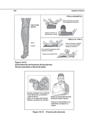 Capítulo Catorce254
Figura 14-12
Inmovilización de fracturas de las piernas.
Férula neumática o férula de tabla.
Figura 14-13 Fractura de clavícula.
 