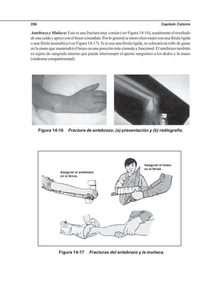 Capítulo Catorce256
AntebrazoyMuñeca:Estaesunafracturamuycomún(verFigura14-16),usualmenteelresultado
deunacaídayapoyoconelbrazoextendido.Porlogeneralseinmovilizamejorconunaférularígida
o una férula neumática (ver Figura 14-17). Si se usa una férula rígida, se colocará un rollo de gasas
enlamanoquemantendráelbrazoenunaposiciónmáscómodayfuncional.Elantebrazotambién
es sujeto de sangrado interno que puede interrumpir el aporte sanguíneo a los dedos y la mano
(síndromecompartimental).
Figura 14-16 Fractura de antebrazo: (a) presentación y (b) radiografía.
Figura 14-17 Fracturas del antebrazo y la muñeca.
 