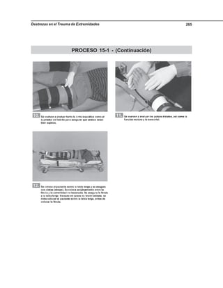 Destrezas en el Trauma de Extremidades 265
PROCESO 15-1 - (Continuación)
 