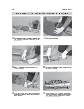 Capítulo Quince266
PROCESO 15-2 - COLOCACIÓN DE FÉRULA DE SAGER
 