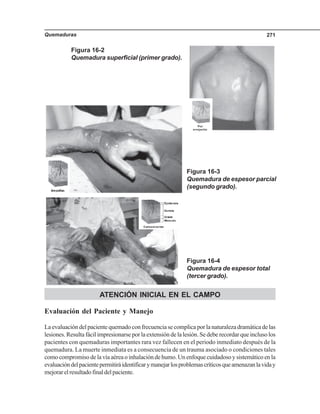 Quemaduras 271
ATENCIÓN INICIAL EN EL CAMPO
Evaluación del Paciente y Manejo
La evaluación del paciente quemado con frecuencia se complica por la naturaleza dramática de las
lesiones. Resulta fácil impresionarse por la extensión de la lesión. Se debe recordar que incluso los
pacientes con quemaduras importantes rara vez fallecen en el periodo inmediato después de la
quemadura. La muerte inmediata es a consecuencia de un trauma asociado o condiciones tales
como compromiso de la vía aérea o inhalación de humo. Un enfoque cuidadoso y sistemático en la
evaluacióndelpacientepermitiráidentificarymanejarlosproblemascríticosqueamenazanlaviday
mejorarelresultadofinaldelpaciente.
Figura 16-3
Quemadura de espesor parcial
(segundo grado).
Figura 16-4
Quemadura de espesor total
(tercer grado).
Figura 16-2
Quemadura superficial (primer grado).
 