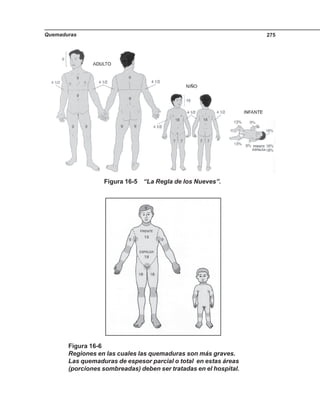 Quemaduras 275
Figura 16-5 “La Regla de los Nueves”.
Figura 16-6
Regiones en las cuales las quemaduras son más graves.
Las quemaduras de espesor parcial o total en estas áreas
(porciones sombreadas) deben ser tratadas en el hospital.
 