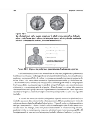 Capítulo Dieciséis280
Elúnicotratamientoadecuadoeslaestabilizacióndelavíaaérea,depreferenciapormediode
laintubaciónnasotraquealomedianteparálisisysecuenciarápidadeintubación.Estosprocedimientos
pueden ser mucho más difíciles de realizar en este caso, comparado con otras circunstancias de
rutina, debido a las alteraciones anatómicas significativas ocasionadas por la inflamación.
Adicionalmente,acausadelairritacióndeltejidodañadoinflamado,puedeocurrirunlaringoespasmo
letal cuando el tubo endotraqueal toque el área de la laringe. Por lo tanto, estos procedimientos se
realizanmejorenlasaladeurgenciasdeunhospitalydebenefectuarseenelcamposólocuandosea
absolutamentenecesarioybajocomunicaciónyórdenesdeladirecciónmédica.Enestospacientes
se debe estar preparado para realizar un procedimiento quirúrgico en la vía aérea si no es posible
intubarlos.
Laslesionesporinhalacióndehumo(verFigura16-10)sonelresultadodequímicostóxicos
inhaladosquecausandañoestructuralalascélulaspulmonares.Elhumopuedecontenercientosde
químicostóxicosquedañanlasdelicadascélulasalveolares.Elhumodeproductosplásticosysintéticos
eselquecausamásdaño.Ladestruccióndelostejidosenlosbronquiosylosalvéolospuedetomar
de horas a días. Sin embargo, como estos productos encontrados en el humo son muy irritantes,
pueden precipitar un broncoespasmo o espasmo arterial coronario en pacientes susceptibles. El
broncoespasmo debe tratarse con un beta-agonista inhalado (salbutamol o albuterol) y oxígeno.
Figura 16-8
La inhalación de calor puede ocasionar la obstrucción completa de la vía
aérea por inflamación o edema de la hipofaringe. Lado izquierdo: anatomía
normal; lado derecho: edema proximal a las cuerdas.
Figura 16-9 Signos de peligro en quemaduras de vía aérea superior.
 