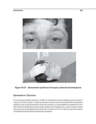Quemaduras 283
Quemaduras Eléctricas
En casos de quemaduras eléctricas, el daño es causado por la electricidad que entra al cuerpo y
viaja a través de los tejidos. El daño resulta de los efectos de la electricidad sobre las funciones
orgánicasyporelcalorgeneradoporelpasodecorriente.Lasextremidadesencomparaciónconel
torso tienen normalmente un mayor riesgo de daño tisular significativo, ya que su menor tamaño
ofrece una mayor densidad de corriente local (ver Figura 16-14). Los factores que determinan la
severidaddeunalesióneléctricaincluyenlassiguientes:
Figura 16-13 Quemaduras químicas en los ojos y atención de emergencia.
 