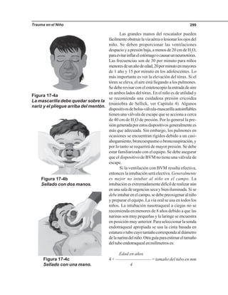 Trauma en el Niño 299
Las grandes manos del rescatador pueden
fácilmenteobstruirlavíaaéreaolesionarlosojosdel
niño. Se deben proporcionar las ventilaciones
despacioyapresiónbaja,amenosde20cmdeH2
O,
paraevitarinflarelestómagoocausarunneumotórax.
Las frecuencias son de 30 por minuto para niños
menoresdeunañodeedad,20porminutoenmayores
de 1 año y 15 por minuto en los adolescentes. Lo
más importante es ver la elevación del tórax. Si el
tórax se eleva, el aire está llegando a los pulmones.
Se debe revisar con el estetoscopio la entrada de aire
en ambos lados del tórax. En el niño es de utilidad y
se recomienda una cuidadosa presión cricoidea
(maniobra de Sellick, ver Capítulo 4). Algunos
dispositivosdebolsa-válvula-mascarillaautoinflables
tienen una válvula de escape que se acciona a cerca
de 40 cm de H2
O de presión. Por lo general la pre-
sióngeneradaporestosdispositivosgeneralmentees
más que adecuada. Sin embargo, los pulmones en
ocasiones se encuentran rígidos debido a un casi-
ahogamiento,broncoespasmoobroncoaspiración,y
por lo tanto se requerirá de mayor presión. Se debe
estar familiarizado con el equipo. Se debe asegurar
que el dispositivo de BVM no tiene una válvula de
escape.
Si la ventilación con BVM resulta efectiva,
entonces la intubación será electiva. Generalmente
es mejor no intubar al niño en el campo. La
intubaciónesextremadamentedifícilderealizaraún
en una sala de urgencias seca y bien iluminada. Si se
debeintubarenelcampo,sedebepreoxigenaralniño
y preparar el equipo. La vía oral se usa en todos los
niños. La intubación nasotraqueal a ciegas no se
recomienda en menores de 8 años debido a que las
narinas son muy pequeñas y la laringe se encuentra
en posición muy anterior. Para seleccionar la sonda
endotraqueal apropiada se usa la cinta basada en
estaturaotubocuyotamañocorrespondaaldiámetro
delanarinadelniño.Otraguíaparaestimareltamaño
deltuboendotraquealenmilímetroses:
Edad en años
4 + ———————— = tamaño del tubo en mm
4
Figura 17-4a
La mascarilla debe quedar sobre la
nariz y el pliegue arriba del mentón.
Figura 17-4b
Sellado con dos manos.
Figura 17-4c
Sellado con una mano.
 