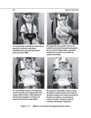 Capítulo Diecisiete310
Figura 17-7 RME en un Asiento de Seguridad para niños.
Un rescatador estabiliza el asiento en
posición vertical y mantiene
estabilización cervical durante el
proceso de la RME.
Un segundo rescatador coloca un
collarín cervical de tamaño apropiado.
Si no se tiene disponible, se puede
improvisar usando una toalla de
manos enrollada.
Un rescatador coloca una pequeña
manta o toalla en el regazo del niño,
luego utiliza cintas o tela adhesiva
ancha para asegurar el tórax y la
pelvis al asiento de seguridad.
El segundo rescatador coloca rollos
de toalla a ambos lados de la cabeza.
Se fija la cabeza con cinta cruzando la
frente y el collarín, sin presionar
sobre el cuello. Colocar sobre la
camilla, elevando la cabecera.
 