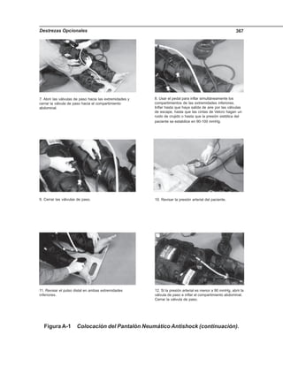 Destrezas Opcionales 367
7. Abrir las válvulas de paso hacia las extremidades y
cerrar la válvula de paso hacia el compartimiento
abdominal.
8. Usar el pedal para inflar simultáneamente los
compartimientos de las extremidades inferiores.
Inflar hasta que haya salida de aire por las válvulas
de escape, hasta que las cintas de Velcro hagan un
ruido de crujido o hasta que la presión sistólica del
paciente se estabilice en 90-100 mmHg.
9. Cerrar las válvulas de paso. 10. Revisar la presión arterial del paciente.
11. Revisar el pulso distal en ambas extremidades
inferiores.
12. Si la presión arterial es menor a 90 mmHg, abrir la
válvula de paso e inflar el compartimiento abdominal.
Cerrar la válvula de paso.
Figura A-1 Colocación del Pantalón Neumático Antishock (continuación).
 