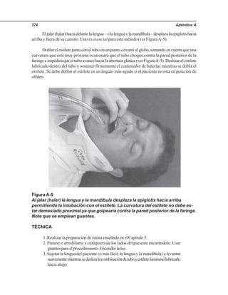 Apéndice A374
Eljalar(halar)haciadelantelalengua–olalenguaylamandíbula–desplazalaepiglotishacia
arriba y fuera de su camino. Esto es esencial para este método (ver FiguraA-5).
Doblar el estilete junto con el tubo en un punto cercano al globo, tomando en cuenta que una
curvatura que esté muy próxima ocasionará que el tubo choque contra la pared posterior de la
faringe e impedirá que el tubo avance hacia la abertura glótica (ver FiguraA-5). Deslizar el estilete
lubricado dentro del tubo y sostener firmemente el contenedor de baterías mientras se dobla el
estilete. Se debe doblar el estilete en un ángulo más agudo si el paciente no está en posición de
olfateo.
Figura A-5
Al jalar (halar) la lengua y la mandíbula desplaza la epiglotis hacia arriba
permitiendo la intubación con el estilete. La curvatura del estilete no debe es-
tar demasiado proximal ya que golpearía contra la pared posterior de la faringe.
Note que se emplean guantes.
TÉCNICA
1. Realizar la preparación de rutina enseñada en el Capítulo 5.
2. Pararse o arrodillarse a cualquiera de los lados del paciente encarándolo. Usar
guantesparaelprocedimiento.Encenderlaluz.
3. Sujetar la lengua del paciente (o más fácil, la lengua y la mandíbula) y levantar
suavementemientrassedeslizalacombinacióndetuboyestileteluminosolubricado
hacia abajo.
 