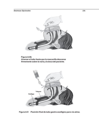 Destrezas Opcionales 379
Figura A-9 Posición final de tubo gastro-esofágico para vía aérea.
Figura A-8b
Avanzar el tubo hasta que la mascarilla descanse
firmemente sobre la nariz y la boca del paciente.
 