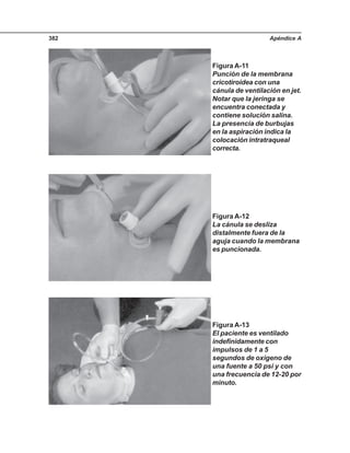 Apéndice A382
Figura A-11
Punción de la membrana
cricotiroidea con una
cánula de ventilación en jet.
Notar que la jeringa se
encuentra conectada y
contiene solución salina.
La presencia de burbujas
en la aspiración indica la
colocación intratraqueal
correcta.
Figura A-12
La cánula se desliza
distalmente fuera de la
aguja cuando la membrana
es puncionada.
Figura A-13
El paciente es ventilado
indefinidamente con
impulsos de 1 a 5
segundos de oxígeno de
una fuente a 50 psi y con
una frecuencia de 12-20 por
minuto.
 