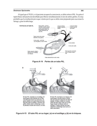 Destrezas Opcionales 385
AligualqueelTGEA,sielpacienterecuperalaconsciencia,sedeberetirarelPtL.Sequitael
tapónblancodelpuertodedesinfladoparaliberarsimultáneamenteelairedeambosglobos.Esmuy
probable que la extubación provoque vómito por lo que se debe estar preparado para succionar la
faringeygirarlatablalarga.
Figura A-14 Partes de un tubo PtL.
Figura A-15 El tubo PtL en su lugar, (a) en el esófago y (b) en la tráquea.
 