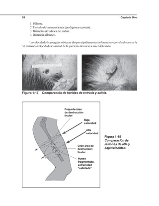 Capítulo Uno26
1. Pólvora.
2.Tamaño de las municiones (perdigones o postas).
3. Diámetro de la boca del cañón.
4.Distanciaalblanco.
La velocidad y la energía cinética se disipan rápidamente conforme se recorre la distancia.A
36 metros la velocidad es la mitad de la que tenía de inicio a nivel del cañón.
Figura 1-17 Comparación de heridas de entrada y salida.
Figura 1-18
Comparación de
lesiones de alta y
baja velocidad.
 