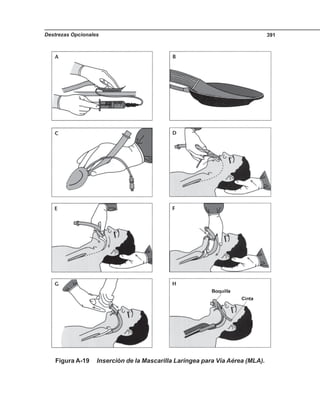 Destrezas Opcionales 391
Figura A-19 Inserción de la Mascarilla Laríngea para Vía Aérea (MLA).
 