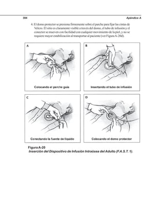 Apéndice A394
Figura A-20
Inserción del Dispositivo de Infusión Intraósea del Adulto (F.A.S.T. 1).
4.Eldomoprotectorsepresionafirmementesobreelparcheparafijarlascintasde
Velcro. El sitio es claramente visible a través del domo, el tubo de infusión y el
conector se mueven con facilidad con cualquier movimiento de la piel, y no se
requiere mayor estabilización al transportar al paciente (ver FiguraA-20d).
 