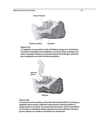Manejo Inicial de la Vía Aérea 67
Figura 4-2a
La epiglotis se encuentra unida al hioides y luego a la mandíbula.
Cuando la mandíbula está relajada y cae hacia atrás, la lengua cae
sobre el paladar blando y la pared posterior de la faringe, mientras
que la epiglotis cae sobre la abertura glótica.
Figura 4-2b
La extensión de la cabeza y elevación del mentón jalará a la lengua y
epiglotis hacia arriba y adelante exponiendo la abertura glótica y
asegurando la vía aérea. En el paciente de trauma, sólo la mandíbula
o el mentón y mandíbula deben desplazarse hacia delante mientras
que la cabeza y el cuello se mantienen en alineación.
 