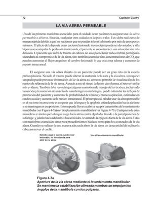 Capítulo Cuatro72
LA VÍA AÉREA PERMEABLE
Una de las primeras maniobras esenciales para el cuidado de un paciente es asegurar unavía aérea
permeable o abierta. Sin ésta, cualquier otro cuidado es de poco valor. Esto debe realizarse de
manera rápida debido a que los pacientes que no puedan tolerar la hipoxia por más de unos pocos
minutos. El efecto de la hipoxia en un paciente lesionado inconsciente puede ser devastador, y si la
hipoxia se acompaña de perfusión inadecuada, el paciente se encontrará en una situación aún más
delicada. El paciente que sufre de trauma de cabeza, no solo puede tener daño cerebral por hipoxia
secundariaalcompromisodelavíaaérea,sinotambiénacumularaltasconcentracionesdeCO2
que
pueden aumentar el flujo sanguíneo al cerebro lesionado lo que ocasiona edema y aumento de
presiónintracraneal.
El asegurar una vía aérea abierta en un paciente puede ser un gran reto en la escena
prehospitalaria. No sólo el trauma puede alterar la anatomía de la cara y la vía aérea, sino que el
sangrado puede provocar obstrucción de la vía aérea así como no permitir la visualización de los
puntos de referencia de la vía aérea.Aunado a esto el riesgo de lesión de columna, el reto se vuelve
másevidente.Tambiéndeberecordarquealgunasmaniobrasdemanejodelavíaaérea,incluyendo
la succión y la inserción de una cánula nasofaríngea u orofaríngea, puede estimular los reflejos de
protección del paciente y aumentar la probabilidad de vómito y broncoaspiración, estimulación
cardiovascularyaumentodelapresiónintracraneal.Elprimerpasoalbrindarunavíaaéreapermeable
enelpacienteinconscienteesasegurarquelalenguaylaepiglotisesténdesplazadashaciaadelante
ysemantenganenesaposición.Estosepuedellevaracaboyaseaporlamaniobradelevantamiento
mandibular(verFigura4-7a)oeldesplazamientomandibular(verFigura4-7b).Cualquieradeestas
maniobras evitarán que la lengua caiga hacia atrás contra el paladar blando o la pared posterior de
lafaringe,yjalaránhaciaadelanteelhuesohioides,levantandolaepiglotisfueradelavíaaérea.Estas
son maniobras esenciales tanto para procedimientos básicos como para los avanzados de la vía
aérea. Cuando se realizan de una manera adecuada abren la vía aérea sin la necesidad de inclinar la
cabeza o mover el cuello.
Figura 4-7a
Apertura de la vía aérea mediante el levantamiento mandibular.
Se mantiene la estabilización alineada mientras se empujan los
ángulos de la mandíbula con los pulgares.
 