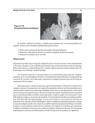 Manejo Inicial de la Vía Aérea 73
Se requiere vigilancia constante y cuidados para mantener una vía aérea permeable en el
paciente.Existenvarioselementosindispensablesparaestatarea:
1. Observación continua del paciente para poder anticipar problemas.
2. Dispositivo adecuado de succión con cánula y manguera de diámetro grande.
3.Dispositivosauxiliaresdelavíaaérea.
Observación
El paciente lesionado está en riesgo de compromiso de su vía aérea incluso si está completamente
consciente y despierto. Esto es debido parcialmente a que muchos pacientes tienen el estómago
lleno, están ansiosos, y están predispuestos a vomitar.Algunos pacientes pueden además tener una
hemorragiaenlaorofaringeydeglutirlasangre.
En virtud de lo anterior, es necesario observar constantemente al paciente por si hubiese
problemas de la vía aérea debidas a la lesión. Un miembro del equipo debe hacerse responsable del
control de la vía aérea y de la adecuada ventilación en cualquier paciente que esté en riesgo de
compromiso de la vía aérea.
Debe percatarse y atender la apariencia general del paciente, la frecuencia respiratoria y
cualquier molestia. En un paciente con respiración espontánea, debe revisar frecuentemente que el
volumentidal(corriente)seaeladecuadosintiéndolosobrelabocaynarizdelpacienteyobservando
los movimientos de la pared torácica. Revise las fuentes de oxígeno regularmente para asegurarse
que se está administrando a un flujo o porcentaje dado. Limpie la sangre y las secreciones. Usted
debelimpiarlasangreysecrecionesdeinmediato.Estéalpendientederuidosqueindiquenproble-
mas. Esté alerta ante este signo de peligro: la respiración ruidosa es una respiración obstruida. Si
elpacientetienecolocadountuboendotraqueal,vigilelacomplianza(expansión)pulmonarybusque
lacausadecualquiercambioenlamisma.Siesposiblemonitoricelaposicióndeltuboporoximetría
de pulso y con la medición continua de CO2
espirado (ver Capítulo 5). Considere que un paciente
combativo está hipóxico hasta que una evaluación rápida y sistémica lo descarte. Se recomienda
ampliamente el uso de la oximetría de pulso en todos los pacientes de trauma (ver Capítulo 5).
Figura 4-7b
Desplazamiento mandibular.
 