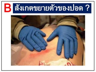 สังเกตขยายตัวของปอด ?
B
 