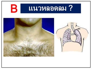 B แนวหลอดลม ?
 