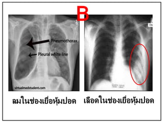 ลมในช่องเยื่อหุ้มปอด เลือดในช่องเยื่อหุ้มปอด
B
 