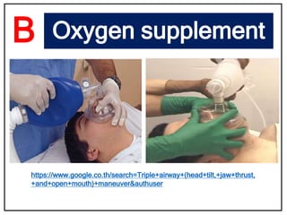 Oxygen supplement
https://www.google.co.th/search=Triple+airway+(head+tilt,+jaw+thrust,
+and+open+mouth)+maneuver&authuser
B
 