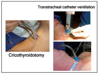 Cricothyroidotomy
Transtracheal catheter ventilation
 