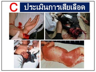 ประเมินการเสียเลือด
C
 