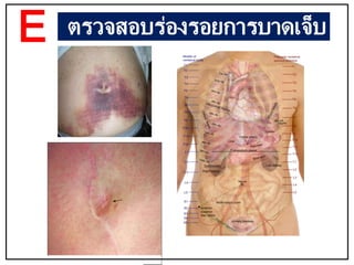 ตรวจสอบร่องรอยการบาดเจ็บ
E
 