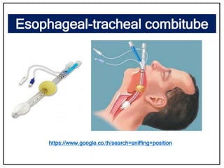 Esophageal-tracheal combitube
https://www.google.co.th/search=sniffing+position
 