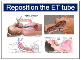 Reposition the ET tube
 