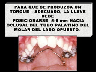 PARA QUE SE PRODUZCA UN TORQUE – ADECUADO, LA LLAVE DEBE POSICIONARSE  5-6 mm HACIA OCLUSAL DEL TUBO PALATINO DEL MOLAR DEL LADO OPUESTO .  