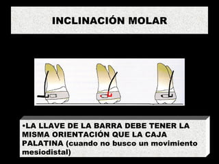 INCLINACIÓN MOLAR LA LLAVE DE LA BARRA DEBE TENER LA MISMA ORIENTACIÓN QUE LA CAJA PALATINA (cuando no busco un movimiento mesiodistal) 