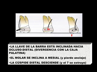 LA LLAVE DE LA BARRA ESTÁ INCLINADA HACIA OCLUSO-DISTAL (DIVERGENCIA CON LA CAJA PALATINA) EL MOLAR SE INCLINA A MESIAL (y pierde anclaje) LA CÚSPIDE DISTAL DESCIENDE (y el 7 se extruye) 