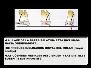 ACTIVACIÓN MESIODISTAL LA LLAVE DE LA BARRA PALATINA ESTÁ INCLINADA HACIA GÍNGIVO-DISTAL SE PRODUCE INCLINACIÓN DISTAL DEL MOLAR (mayor anclaje) LAS CÚSPIDES MESIALES DESCIENDEN Y LAS DISTALES SUBEN (lo que intruye al 7) 