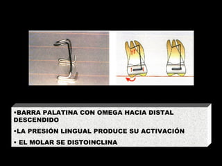 INCLINACIÓN MESIODISTAL BARRA PALATINA CON OMEGA HACIA DISTAL DESCENDIDO LA PRESIÓN LINGUAL PRODUCE SU ACTIVACIÓN EL MOLAR SE DISTOINCLINA 