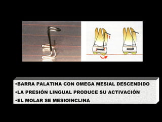 INCLINACIÓN MESIODISTAL BARRA PALATINA CON OMEGA MESIAL DESCENDIDO LA PRESIÓN LINGUAL PRODUCE SU ACTIVACIÓN EL MOLAR SE MESIOINCLINA 