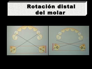 Rotación distal  del molar 