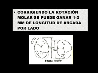BARRA PALATINA CORRIGIENDO LA ROTACIÓN MOLAR SE PUEDE GANAR 1-2 MM DE LONGITUD DE ARCADA POR LADO 