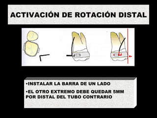 ACTIVACIÓN DE ROTACIÓN DISTAL INSTALAR LA BARRA DE UN LADO EL OTRO EXTREMO DEBE QUEDAR 5MM POR DISTAL DEL TUBO CONTRARIO 