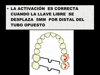 LA ACTIVACIÓN  ES CORRECTA CUANDO LA LLAVE LIBRE  SE DESPLAZA  5MM  POR DISTAL DEL TUBO OPUESTO 