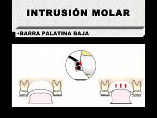 INTRUSIÓN MOLAR BARRA PALATINA BAJA 