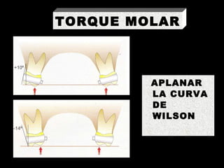 APLANAR LA CURVA DE WILSON TORQUE MOLAR 