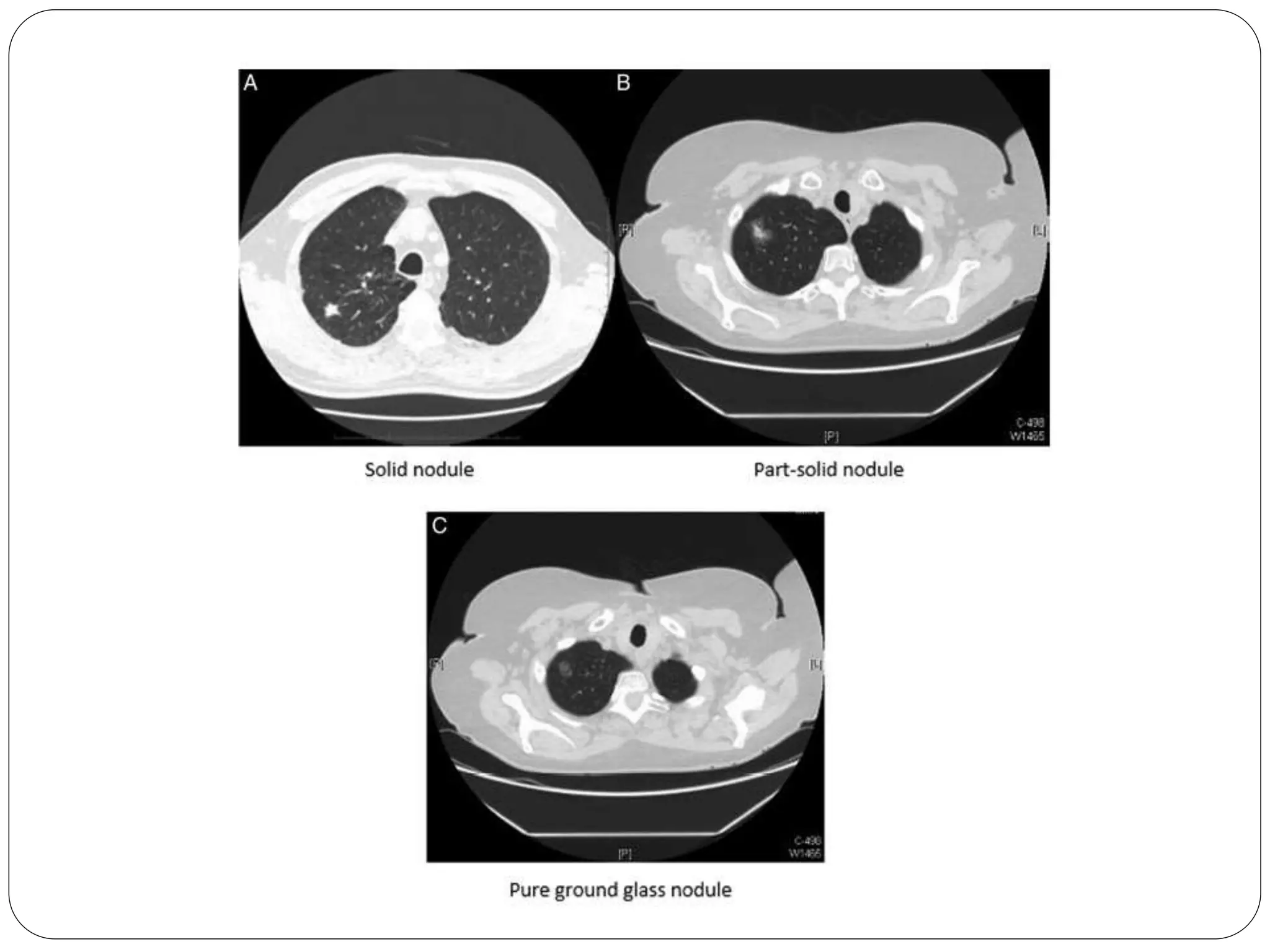 British Thoracic Society Guidelines on Lung nodules #Vama2015 | PPTX