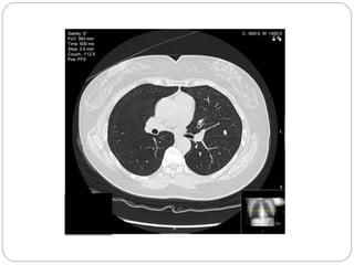British Thoracic Society Guidelines on Lung nodules #Vama2015 | PPTX