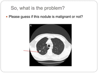 British Thoracic Society Guidelines on Lung nodules #Vama2015 | PPTX