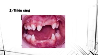 BỌC RĂNG SỨ ZIRCONIA THẨM MỸ UY TÍN  Nha khoa uy tín quận Gò Vấp TPHCM   Nha khoa Tâm Việt