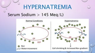 HYPERNATREMIA
Serum Sodium > 145 Meq/L)
 