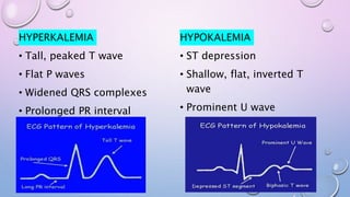HYPERKALEMIA
• Tall, peaked T wave
• Flat P waves
• Widened QRS complexes
• Prolonged PR interval
HYPOKALEMIA
• ST depression
• Shallow, flat, inverted T
wave
• Prominent U wave
 